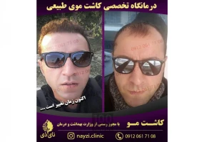 کاشت موی طبیعی