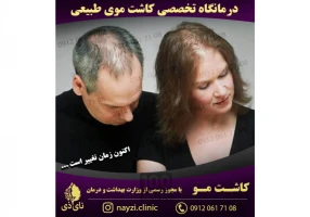 کاشت موی طبیعی