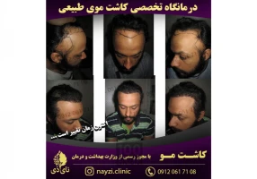 کاشت موی طبیعی