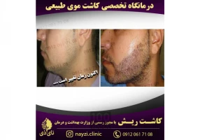 کاشت موی طبیعی