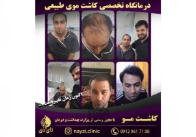 کاشت موی طبیعی