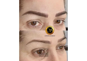 فیبروز و میکروبلیدینگ شهسوار سمیه شهبازی