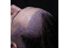 کاشت مو و ابرو و مژه به صورت تخصصی