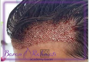اموزش کاشت مو در اصفهان با ارائه مدرک
