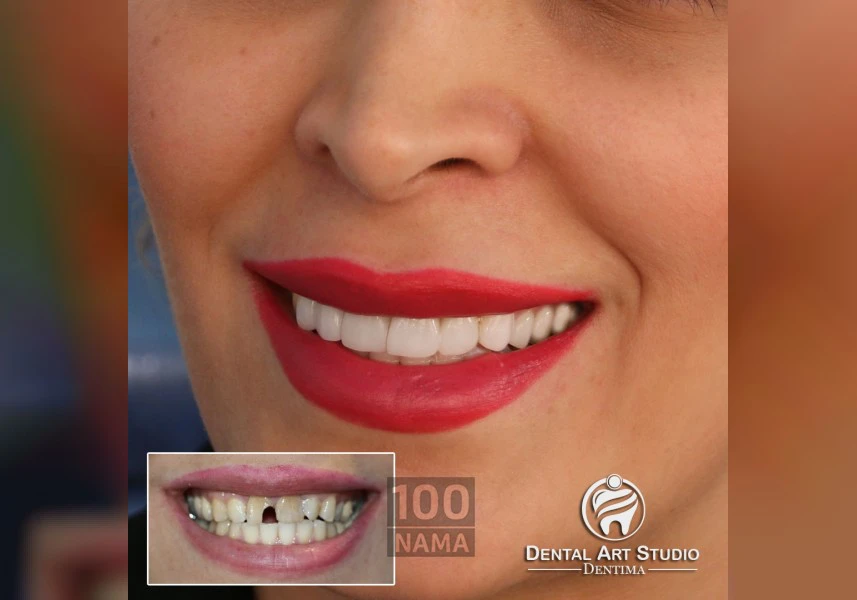 دندانپزشکی زیبایی ، ایمپلنت و طراحی لبخند دکتر سپهریان