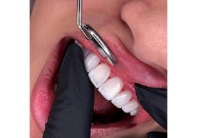 کامپوزیت دندان ایمپلنت لمینت عصب کشی