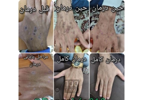 درمانگر سنتی در ایلام