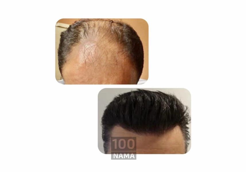 جشنواره کاشت مو و ابرو