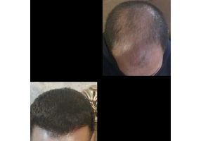 جشنواره کاشت مو و ابرو
