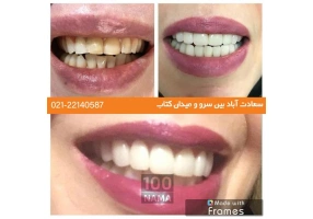 مزایای لمینت دندان در دندانپزشکی دکتر بالوی