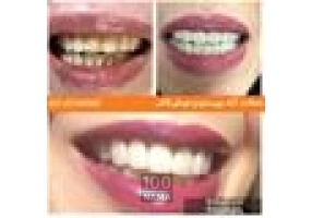 مزایای لمینت دندان در دندانپزشکی دکتر بالوی