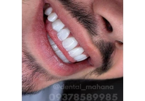 کامپوزیت لمینت عصب کشی کرج دندانپزشکی ماهانا